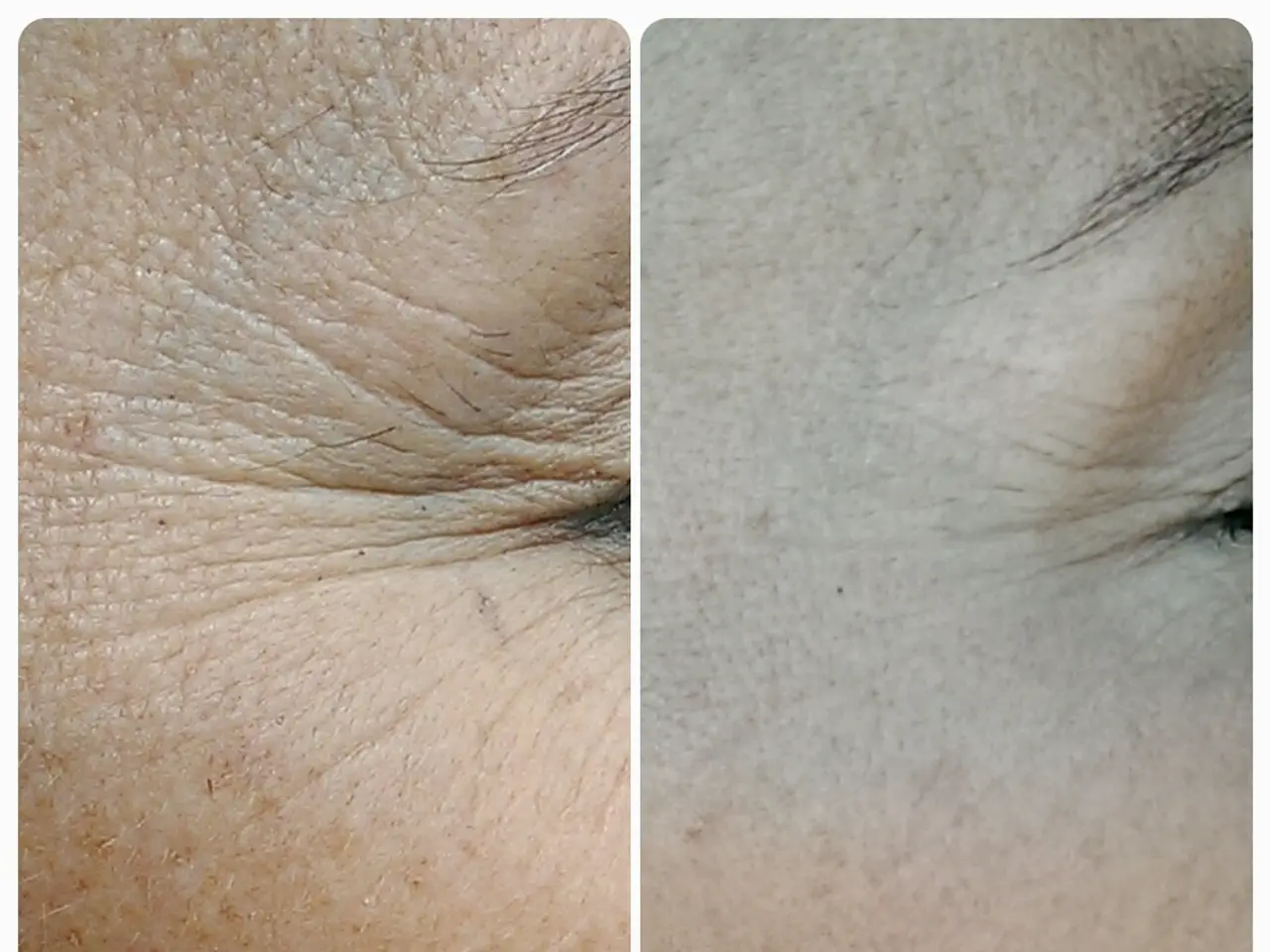 Images and Information Regarding Initial-Stage Skin Cancer